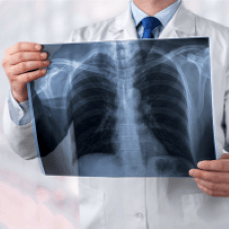 Doctor holding an X-Ray of a ribcage