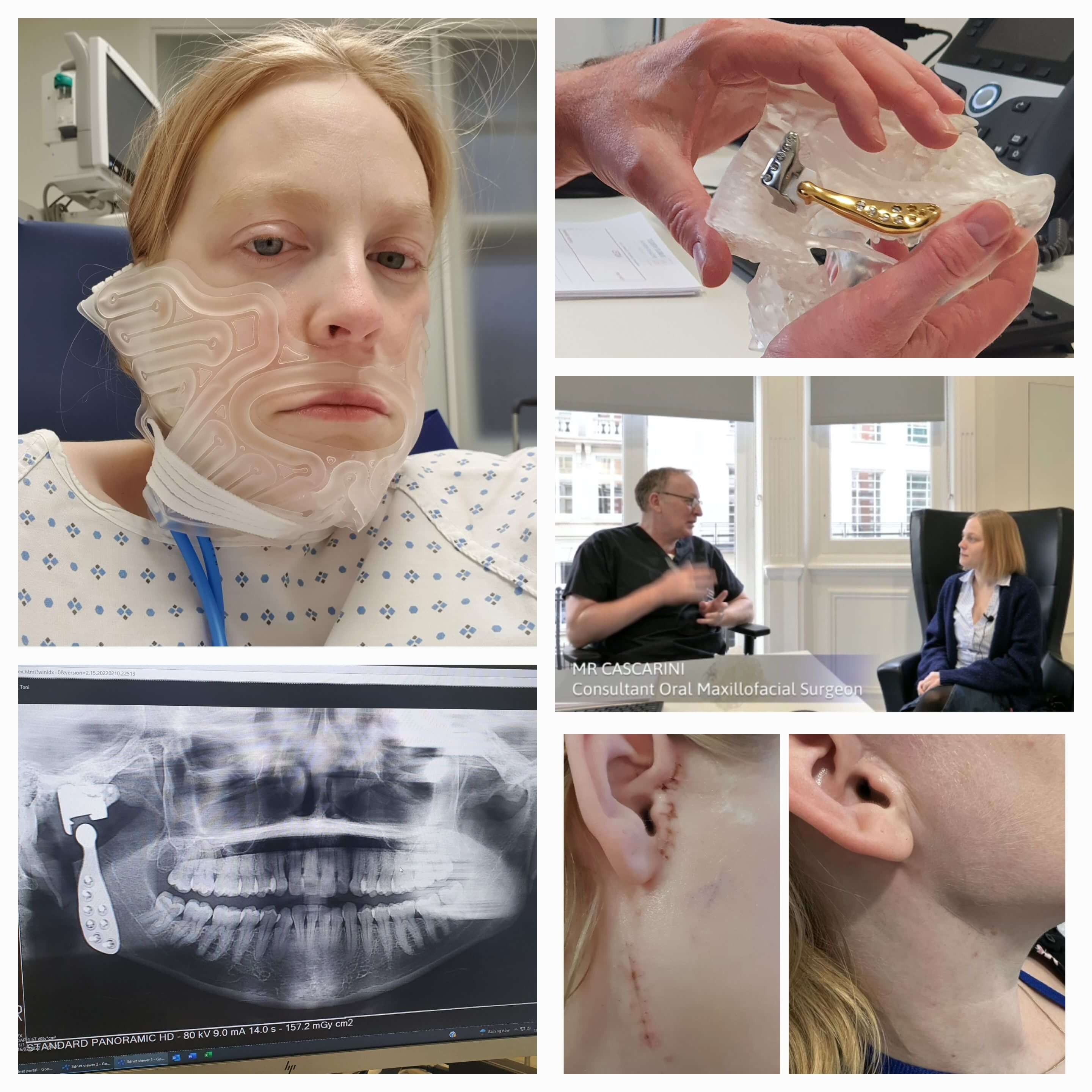 Toni Bull - Compilation of titanium jaw join replacement